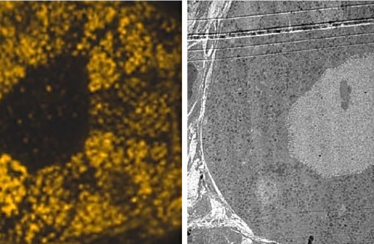 Correlative Light and Electron Microscopy (CLEM) Based Analysis of Disease